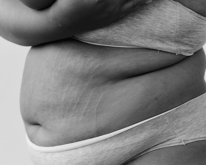 How to tell if you have diastasis recti