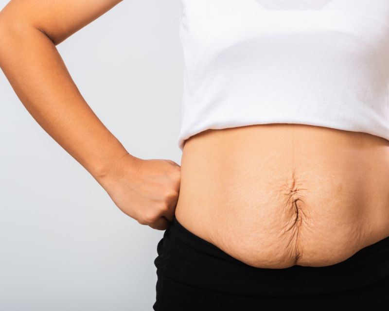 Diastasis recti can affect your postpartum weight training journey.