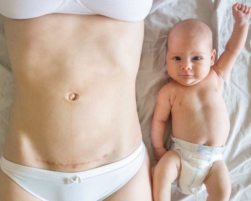 When can I lift weights postpartum? It may heavily depend on your delivery type.